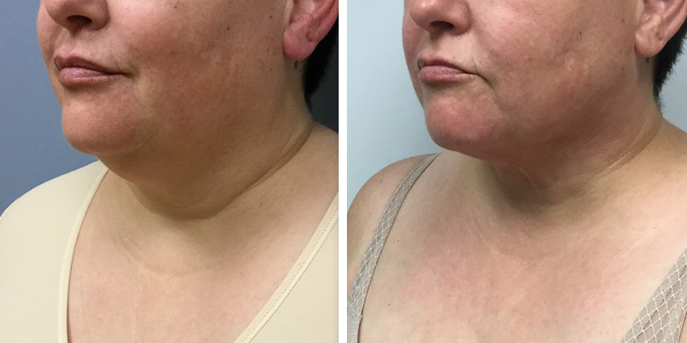 Azura Dr. Tellis Skin Tightening