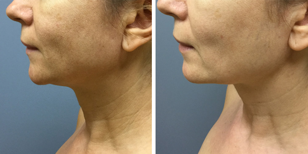 Azura Dr. Tellis Skin Tightening