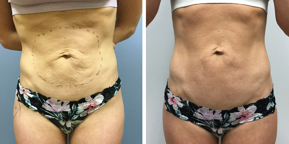 Azura Dr. Tellis Skin Tightening