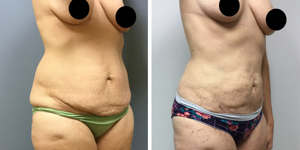 Azura Dr. Tellis Skin Tightening