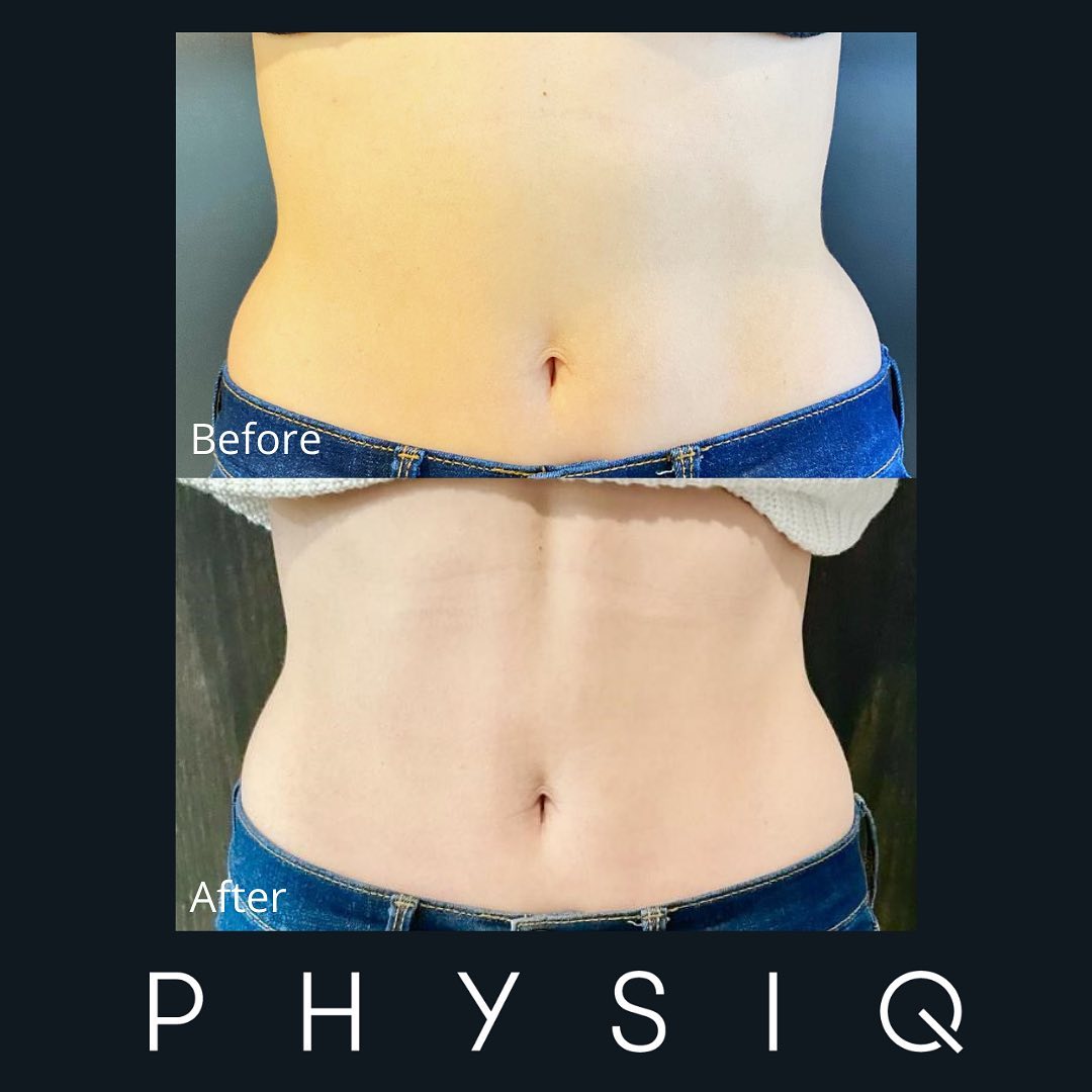 PHYSIQ Before and After Offered at Azura Skin Care Center