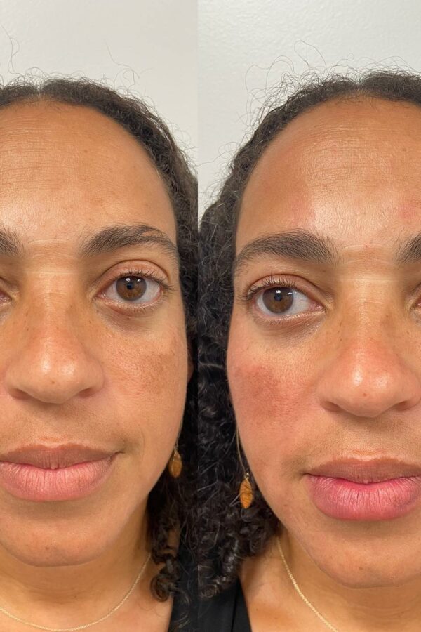 Azura Skin Care Center Cary NC Before and After - Voluma and Versa 01