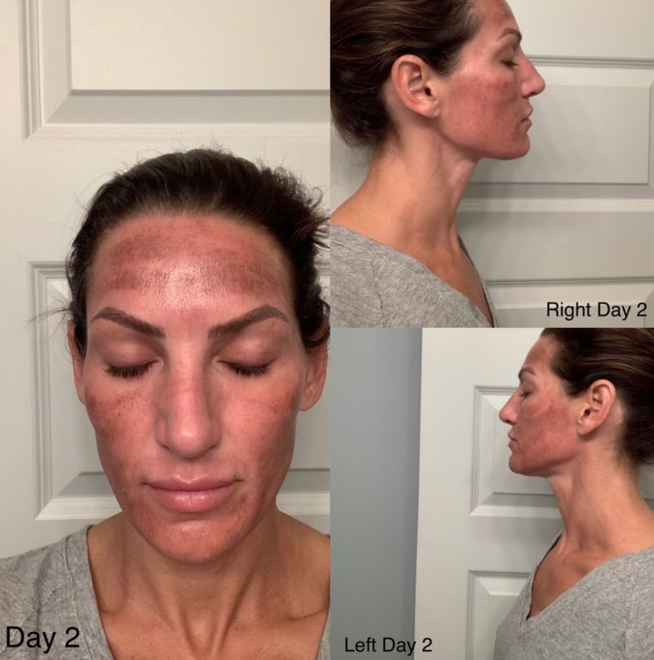 RevePeel Day 2 at Azura Skin Care Center