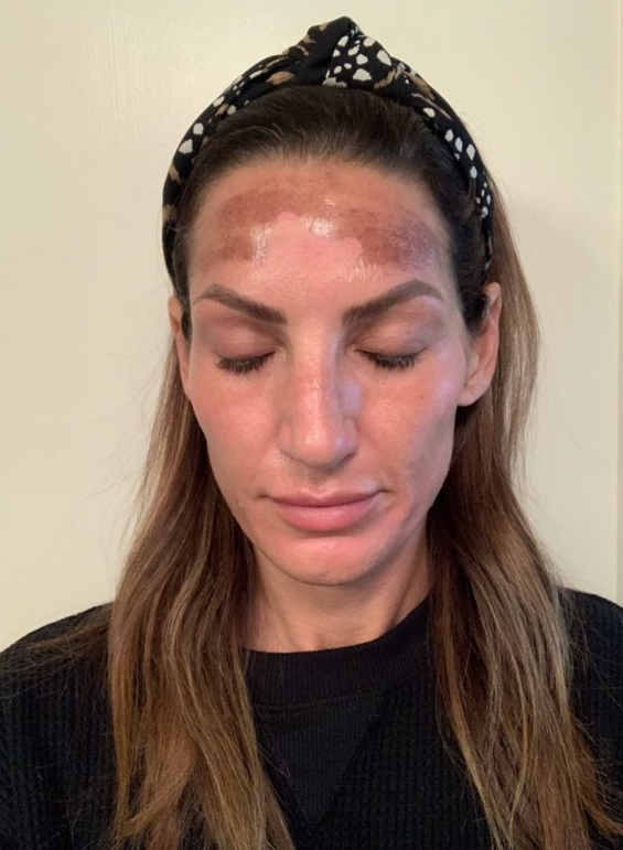 RevePeel at Azura Skin Care Center