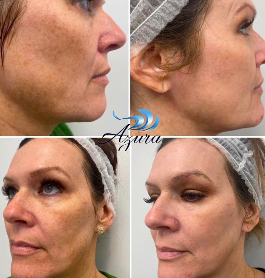 Enlighten Chemical Peel at Azura Skin Care Center
