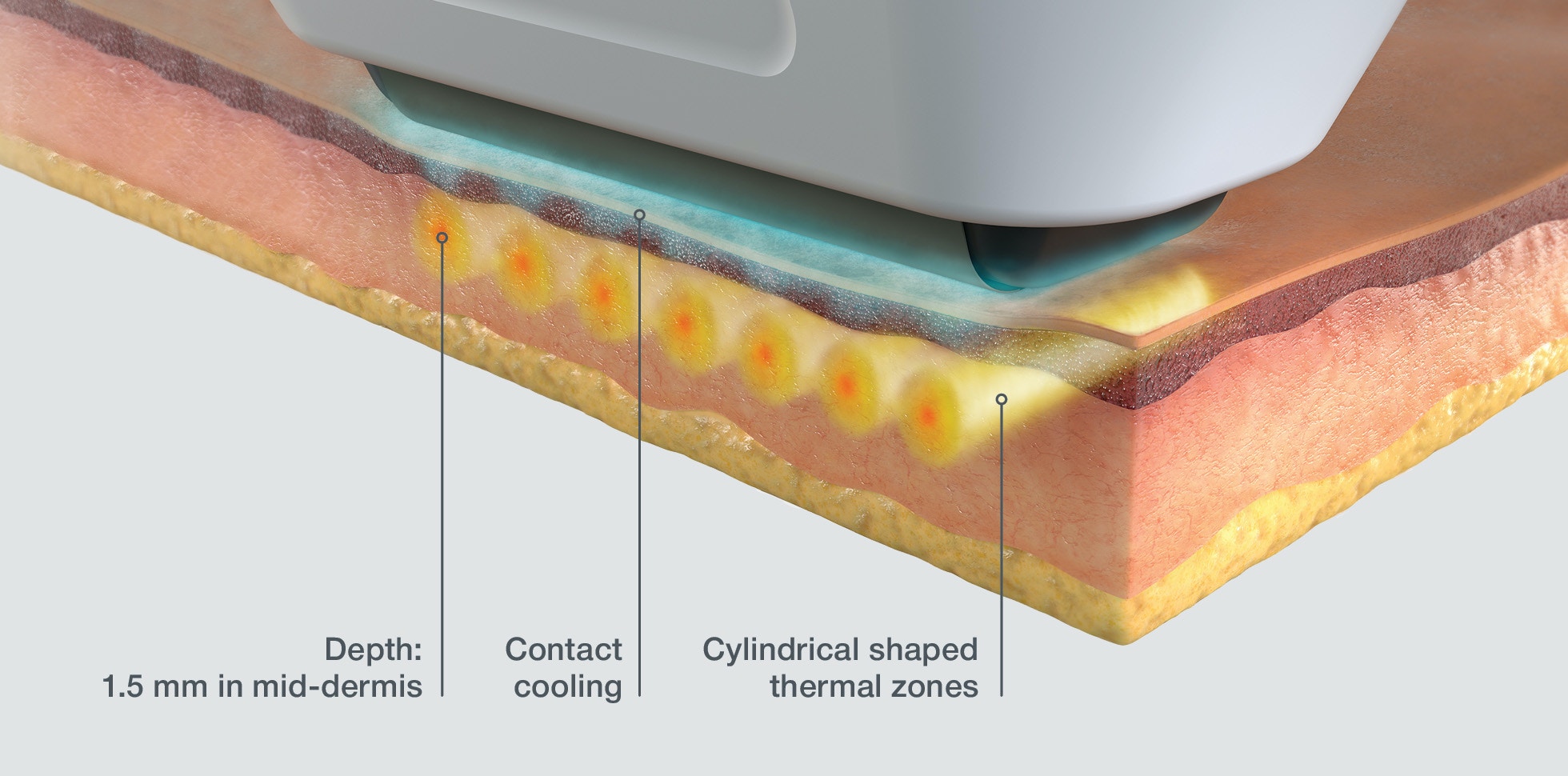 Sofwave™ at Azura Skin