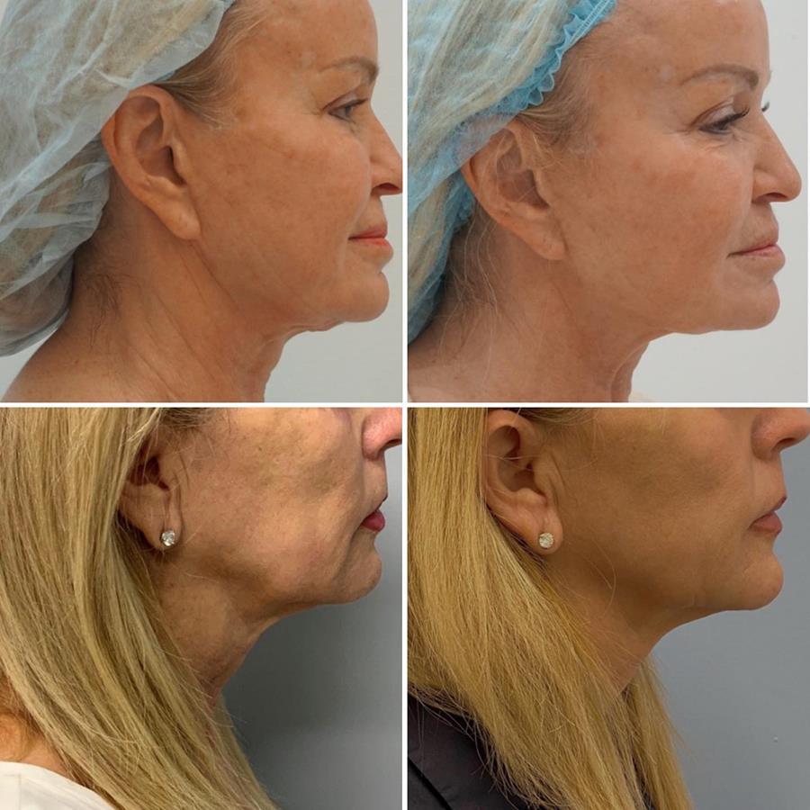 Sofwave at Azura Skin Care Center