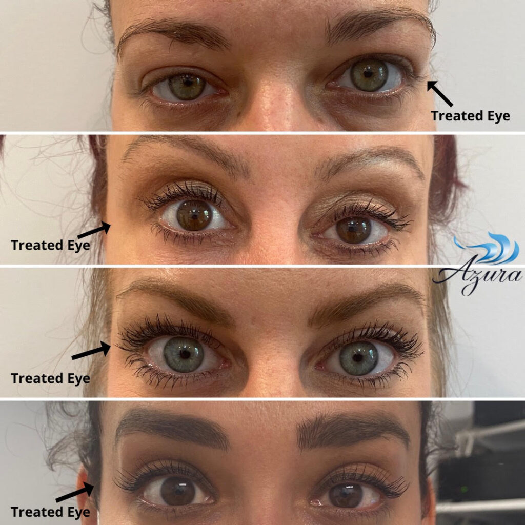 Wake Up With Upneeq® at Azura