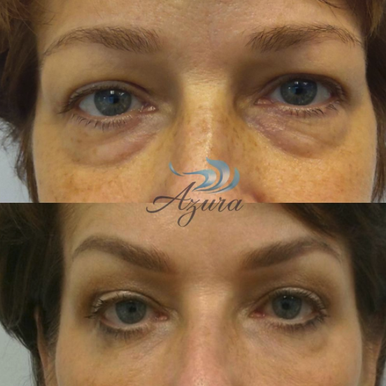 Restylane Dermal Filler March Special 2023