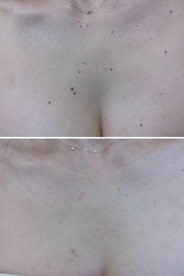 Cherry Angiomas Before and After Azura