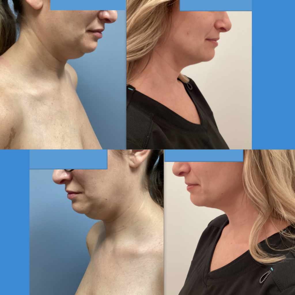 Dr. Tellis at Azura Skin Care Center Before and After 