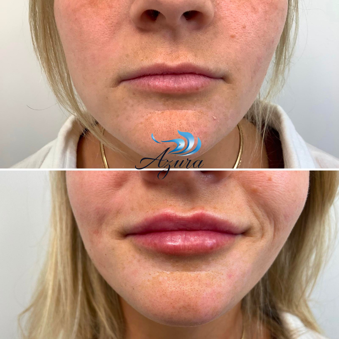 Lip Filler at Azura Skin Care Center in Cary
