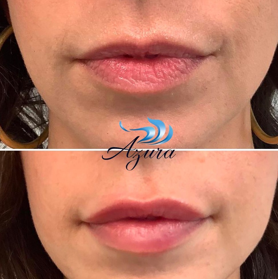 Lip Filler at Azura Skin Care Center