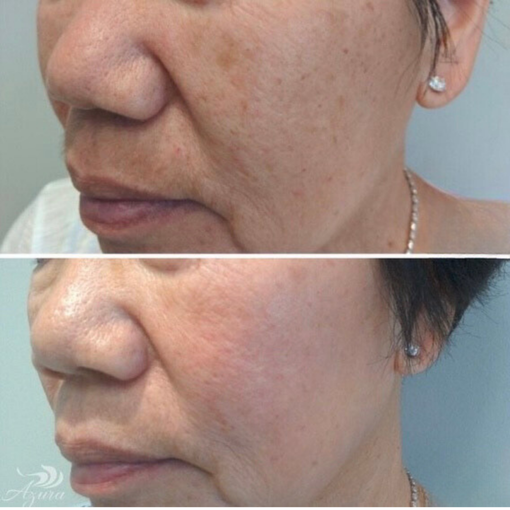 BBL Treatment at Azura Skin Care Center