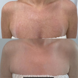 BBL Treatment at Azura Skin Care Center