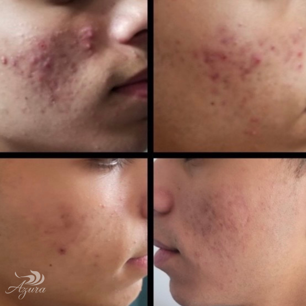 BBL at Azura Skin Care Center