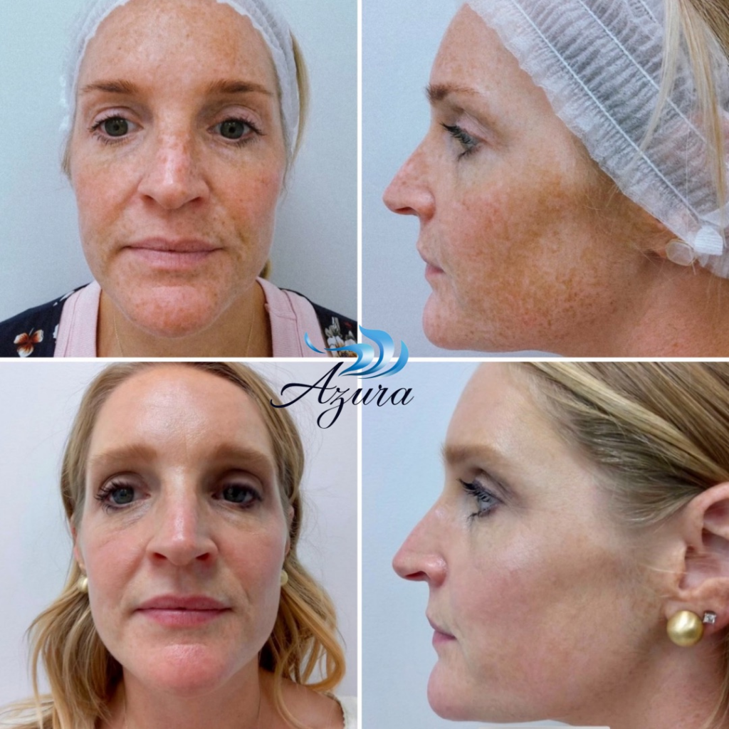 BBL at Azura Skin Care Center