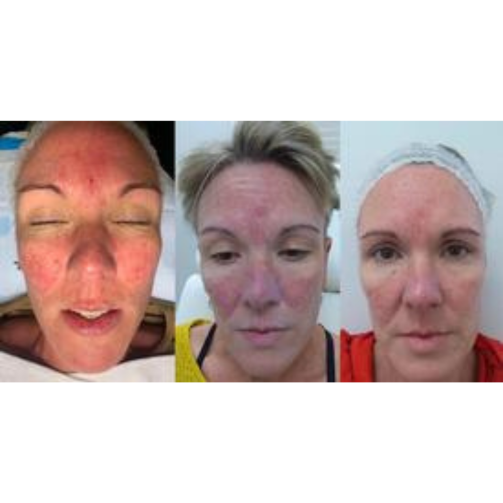 BBL at Azura Skin Care Center in Cary