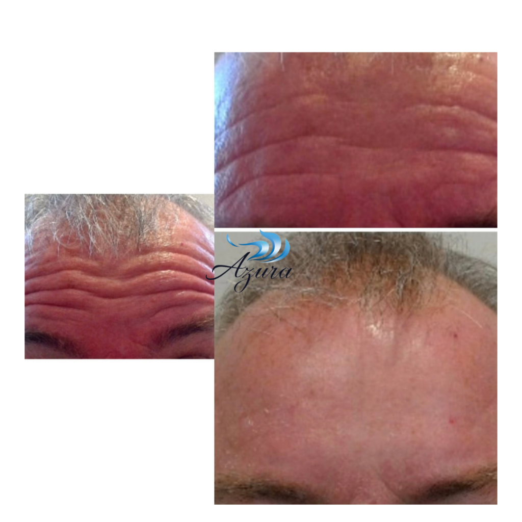 Botox Before and Afters at Azura in Cary