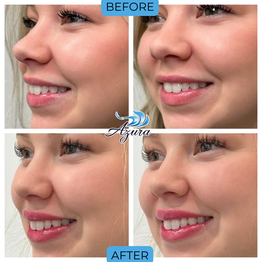 Lip Filler at Azura Skin Care Center