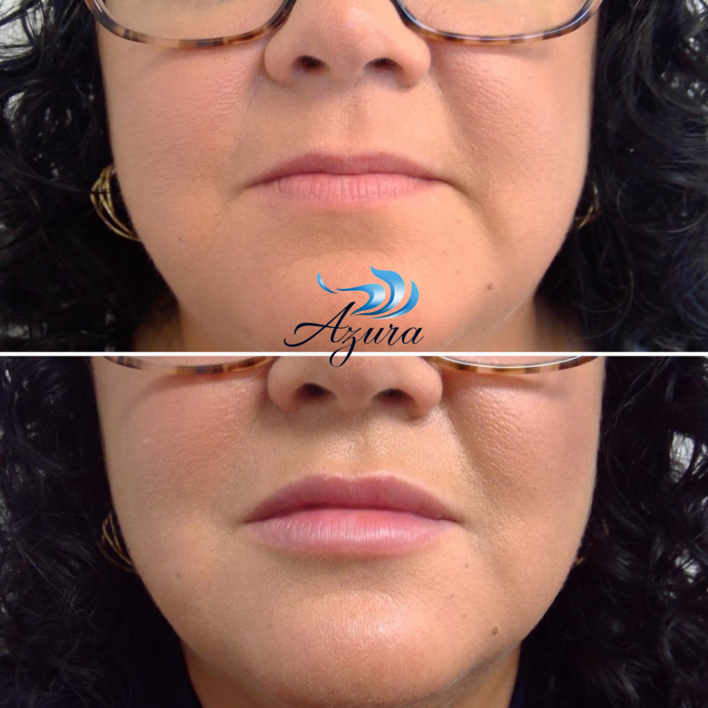 Facial Filler at Azura Skin Care Center