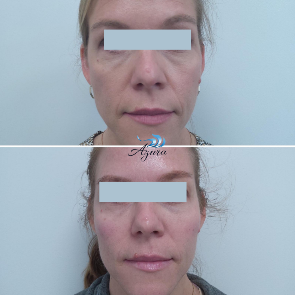 Facial Filler at Azura in Cary