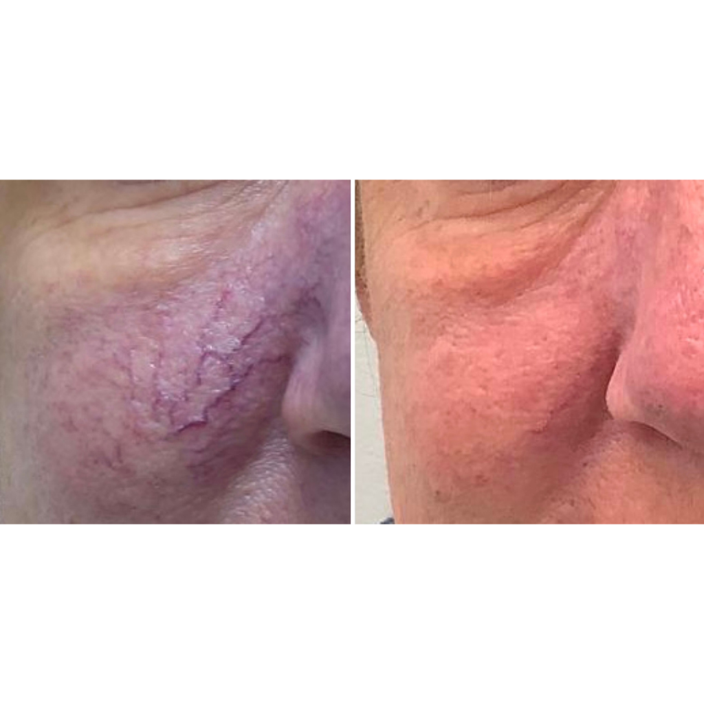 Yag laser treatment for telangetasias at Azura Skin Care Center