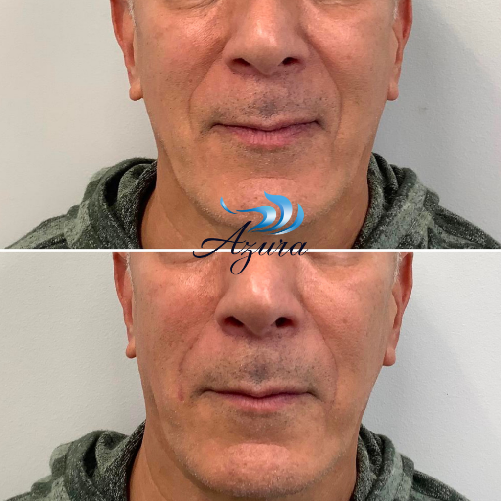 Filler Before and After at Azura