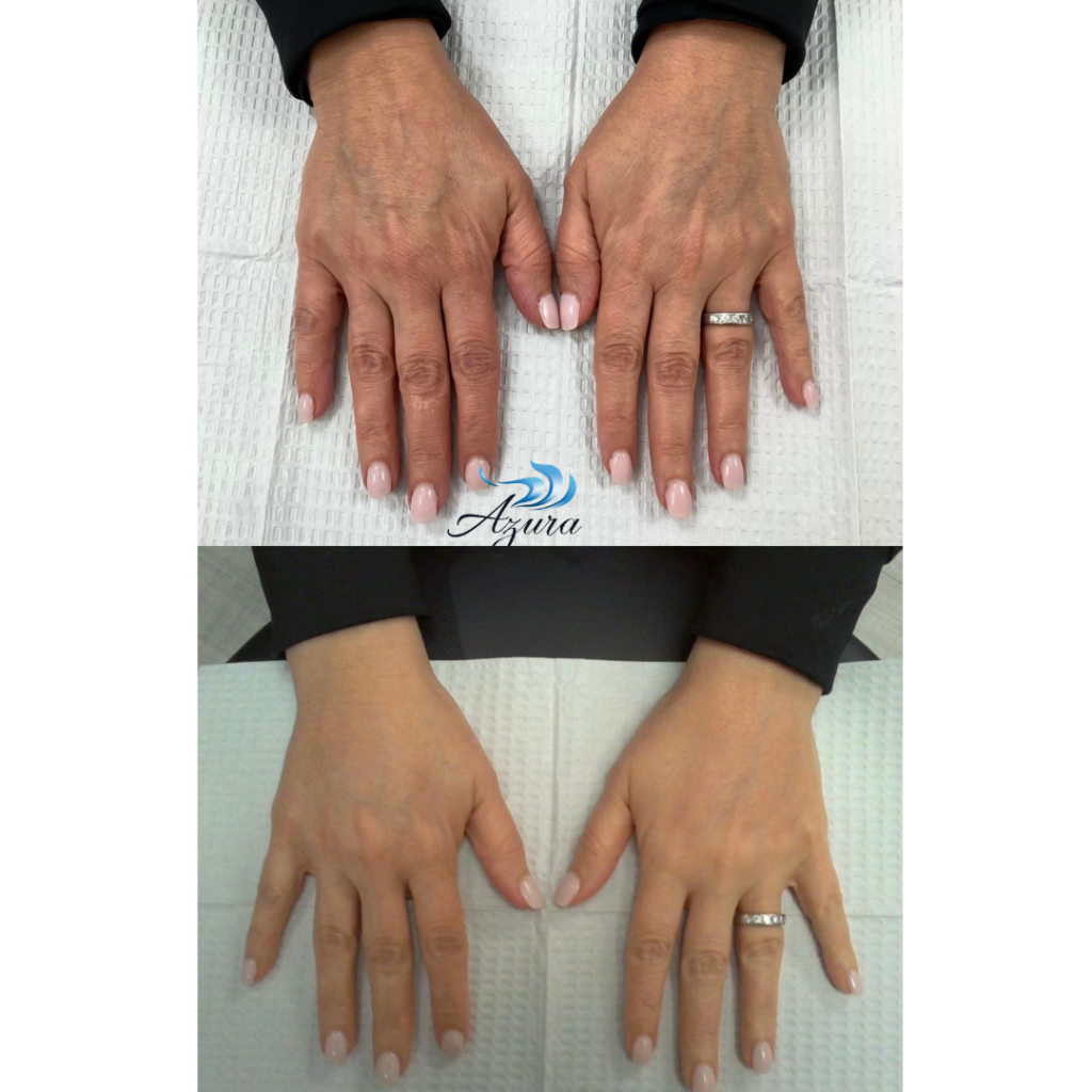 Filler Hand Treatment at Azura Skin Care Center