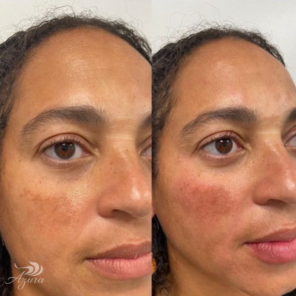 Filler at Azura Skin Care Center