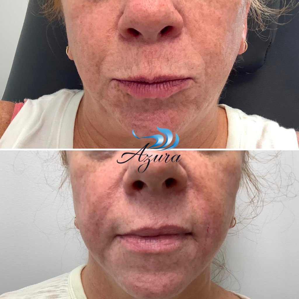 Fillers at Azura Skin Care Center in Cary
