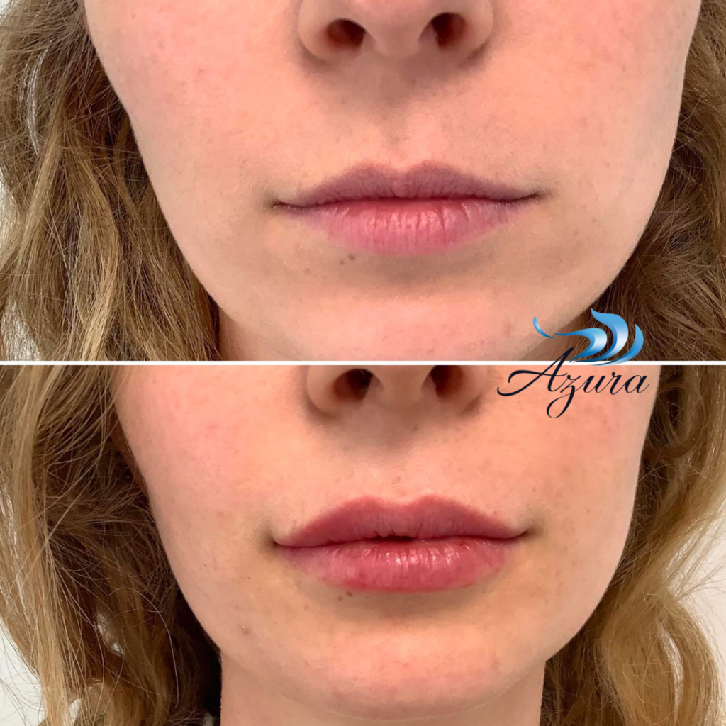 Lip Filler at Azura