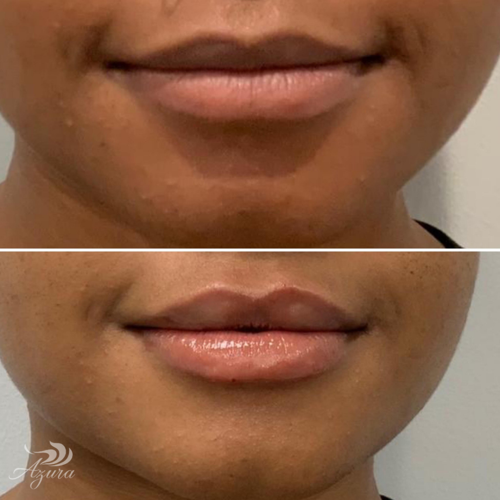 Lip Filler at Azura Skin Care Center