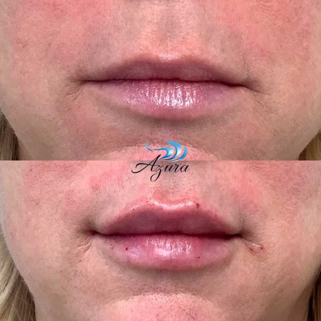 Lip Filler at Azura Skin Care Center