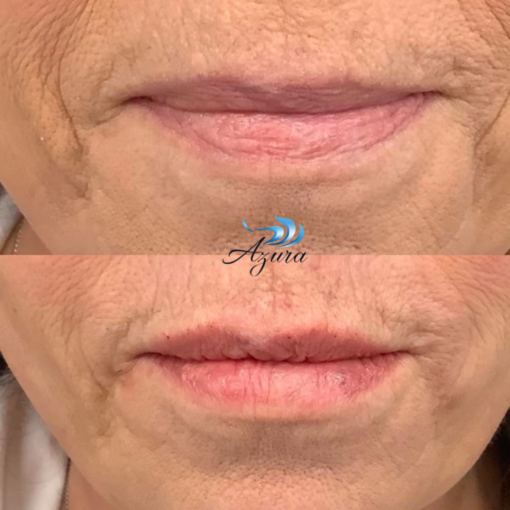 Lip Filler at Azura Skin Care Center in Cary