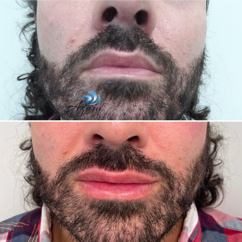 Male Lip Filler at Azura Skin Care Center