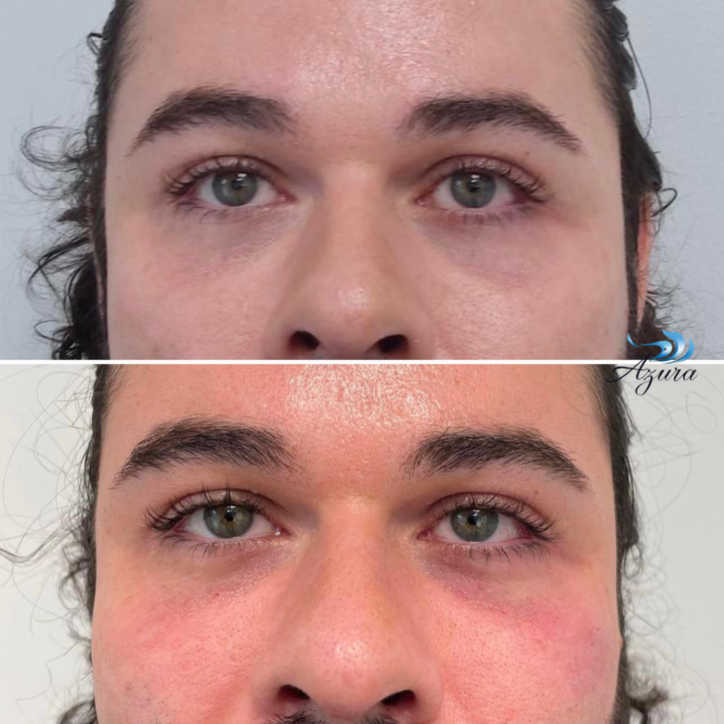 Male Under Eye Filler at Azura Skin Care Center