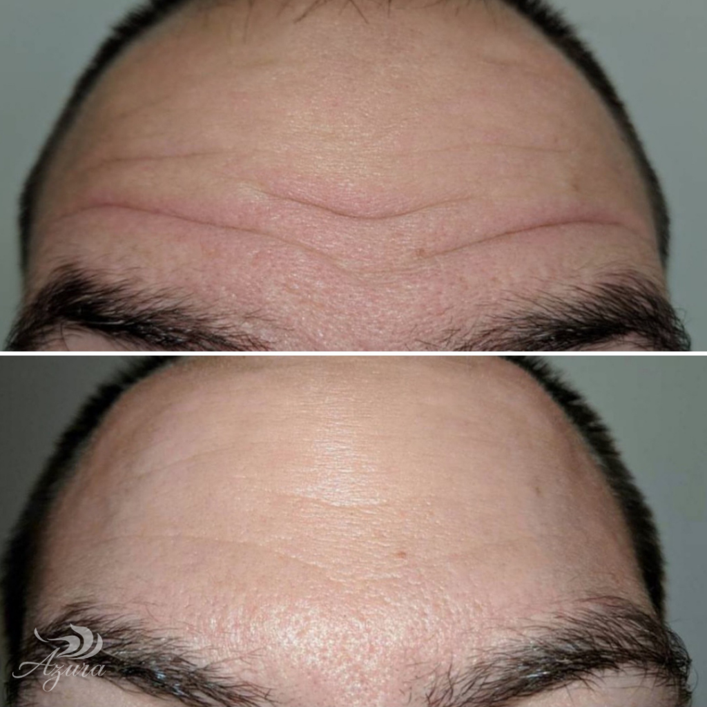 Mens Botox at Azura Skin Care Center