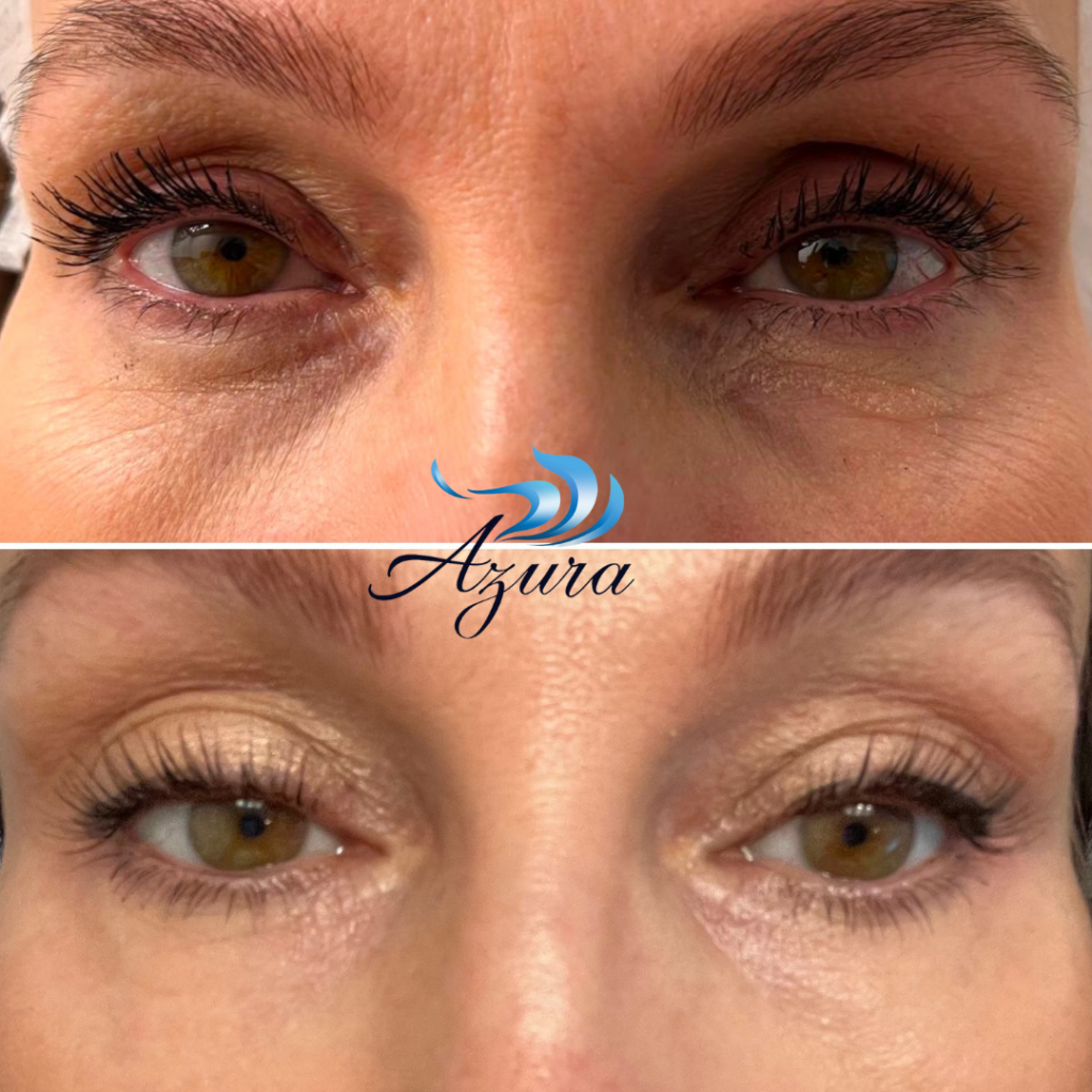 PRP Eye treatment at Azura Skin Care Center