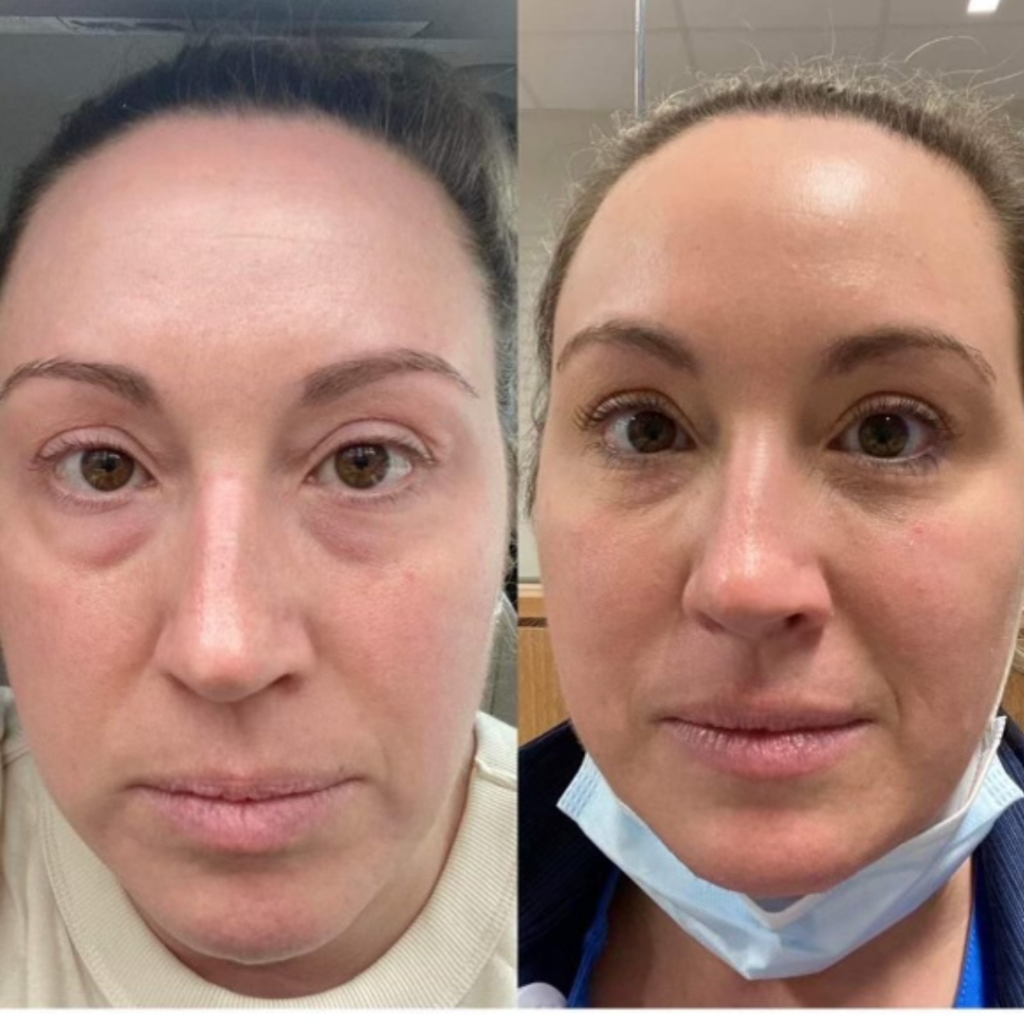 Under Eye Filler at Azura Before and After