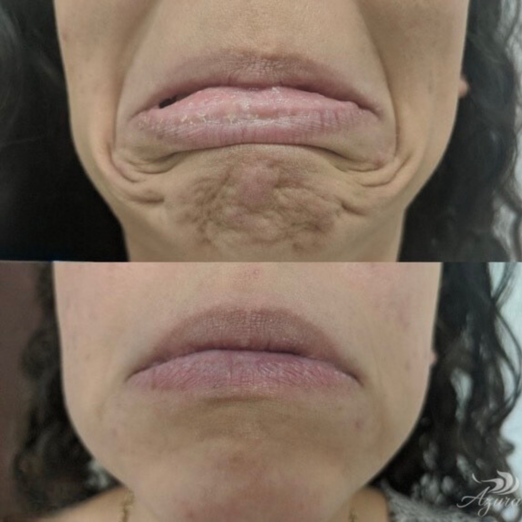 Womens Botox at Azura Skin Care Center