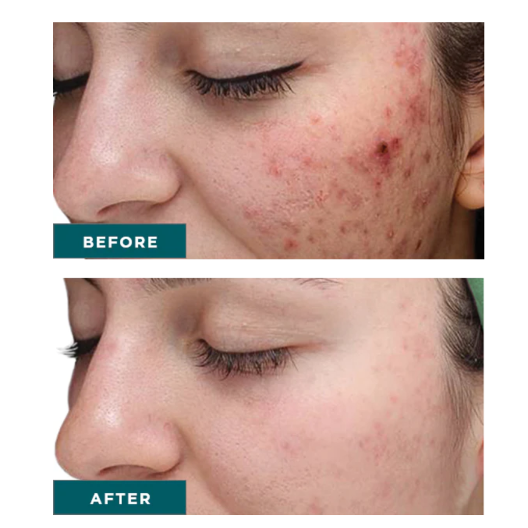 VI Peel Purify With Precision Plus