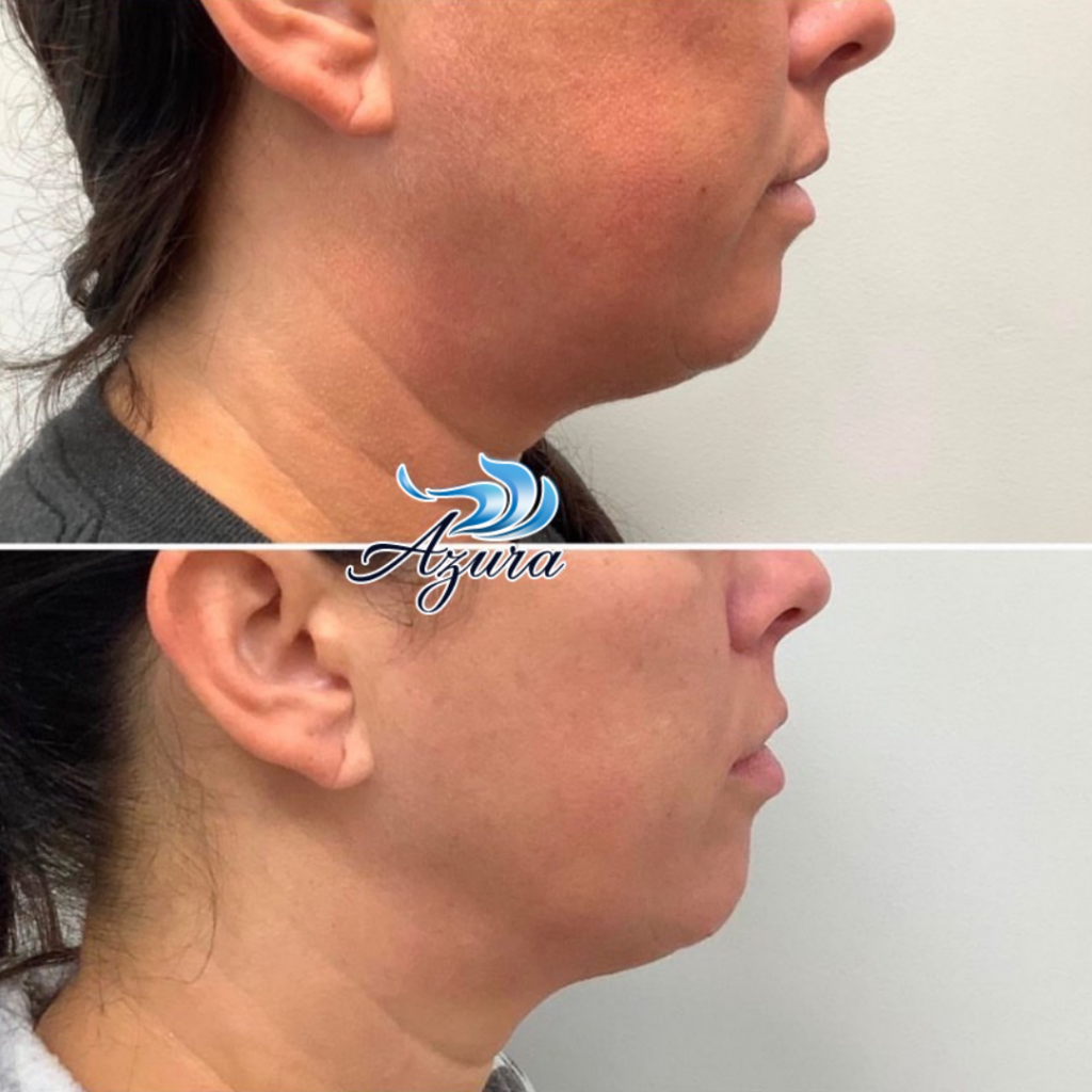 Sofwave at Azura Skin Care Center