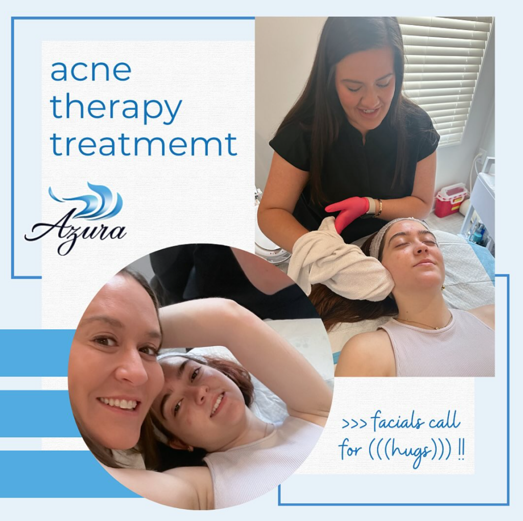 Acne Therapy Treatment at Azura Skin Care Center