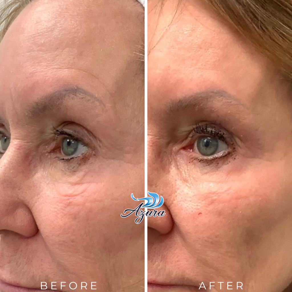 Provoque at Azura Skin Care Center