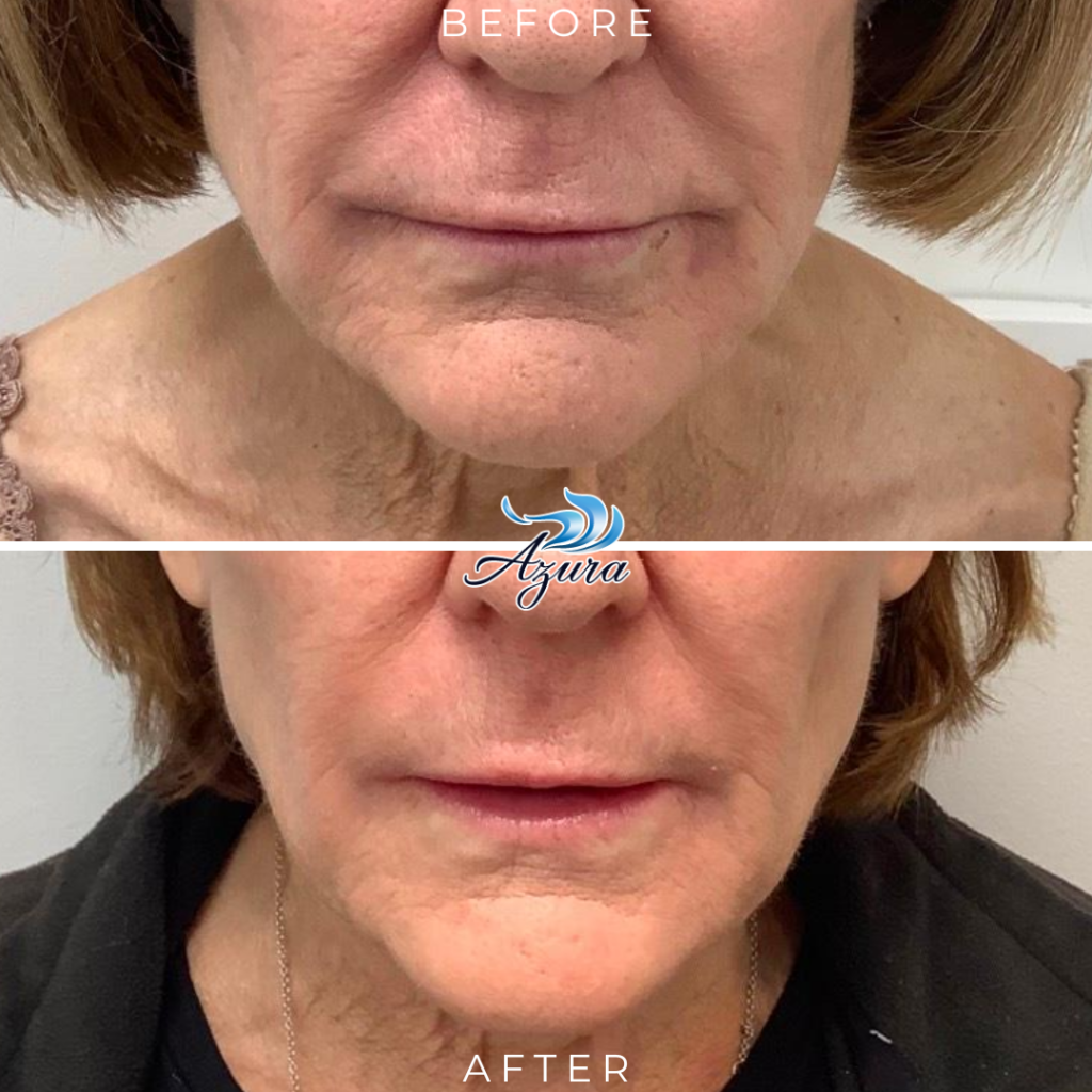 Provoque at Azura Skin Care Center