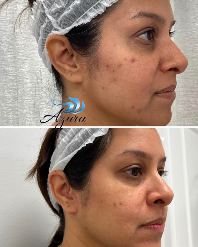 Moxi at Azura Skin Care Center 