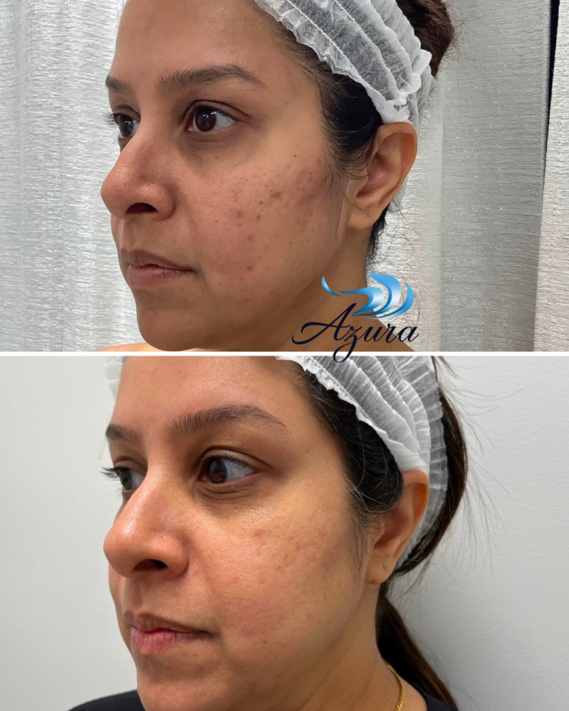 Moxi at Azura Skin Care Center